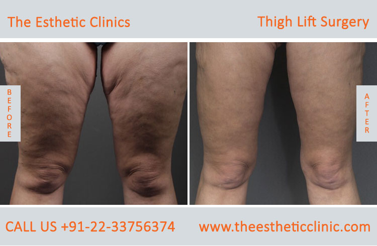 Thigh Lift Surgery, Thigh Reduction before after photos in mumbai india (5)